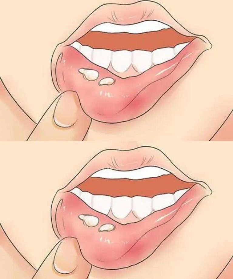 Herpes labiale: tutto quello che c’è da sapere su questa condizione comune, le sue cause, i trattamenti e la prevenzione