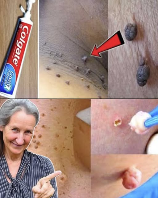 Di’ addio alle verruche e alle escrescenze cutanee senza dolore o sostanze chimiche