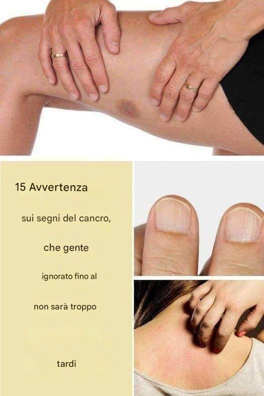 15 segnali allarmanti del cancro che le persone ignorano finché non è troppo tardi