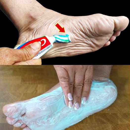 Dentifricio: il segreto per piedi felici!