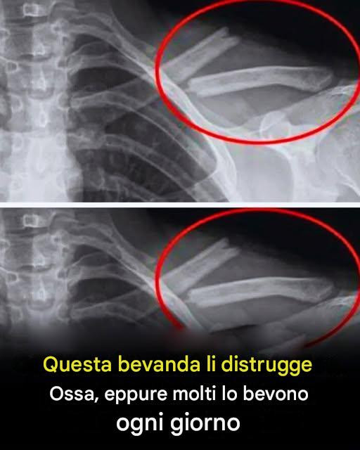 Questa bevanda distrugge le ossa, eppure molte persone la bevono quotidianamente